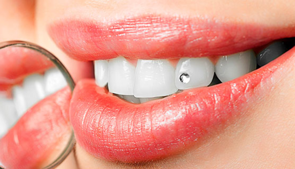 Joyas dentales: el riesgo de una moda