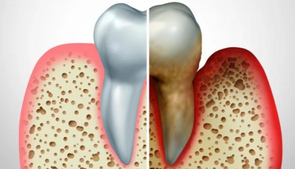 Dental bone loss