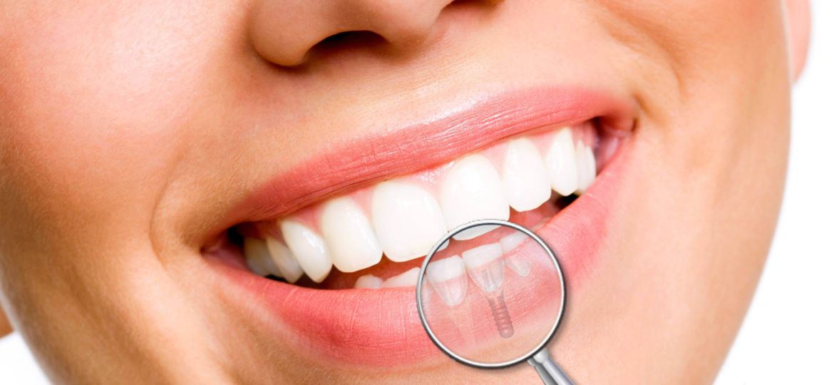 Recomendaciones tras la colocación de implantes dentales