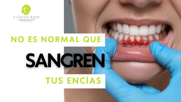 ¿Por qué sangran tus encías?