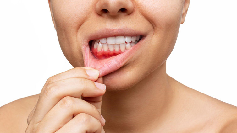 Higiene periodontal profesional en Clínica Bajo Sondaje periodontal con Sonda Florida Cepillos interproximales para cuidado interdental