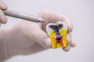 Sellado de conductos y corona en endodoncia
